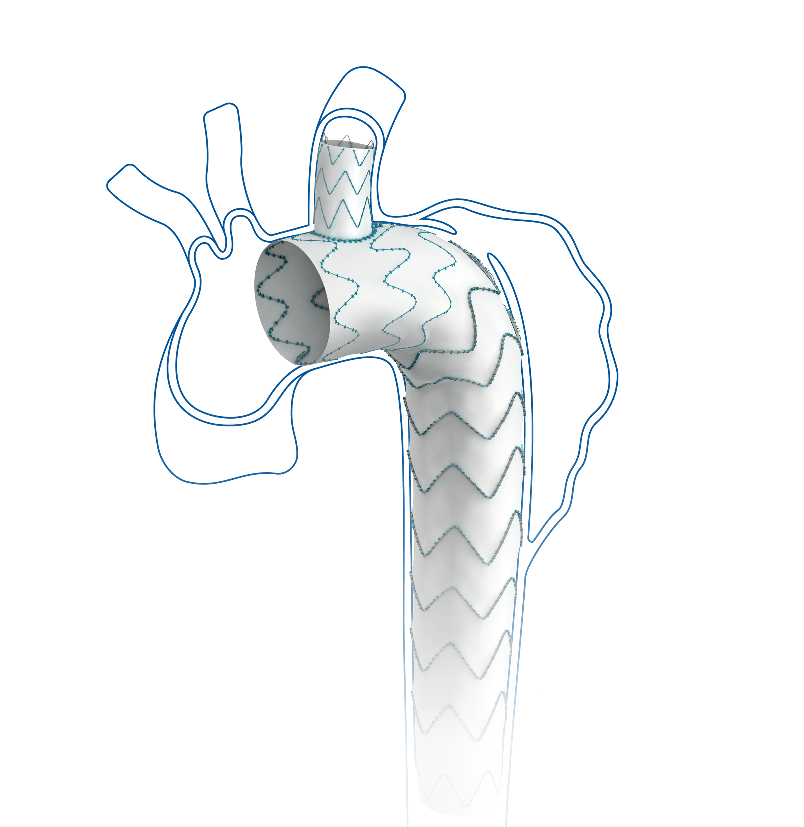 Castor™ Branched Aortic Stent Graft System